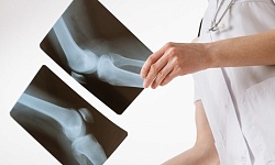 Рентгенография коленного сустава( 2 проекции)