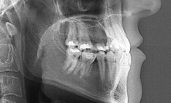 Рентгенография нижней челюсти в боковой проекции