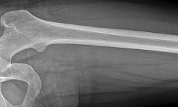 Рентгенография бедренной кости
