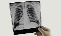 Рентгенография легких цифровая в 2-х проекциях