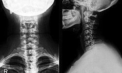 Рентгенография шейного отдела позвоночника ( 2 проекции)