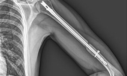 Рентгенография плечевой кости ( 2 проекции)