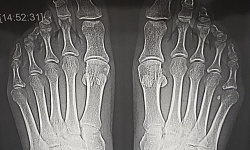 Рентгенография плюсны и фаланг пальцев стопы