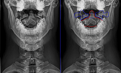 Рентгенография зубовидного отростка (второго шейного позвонка)